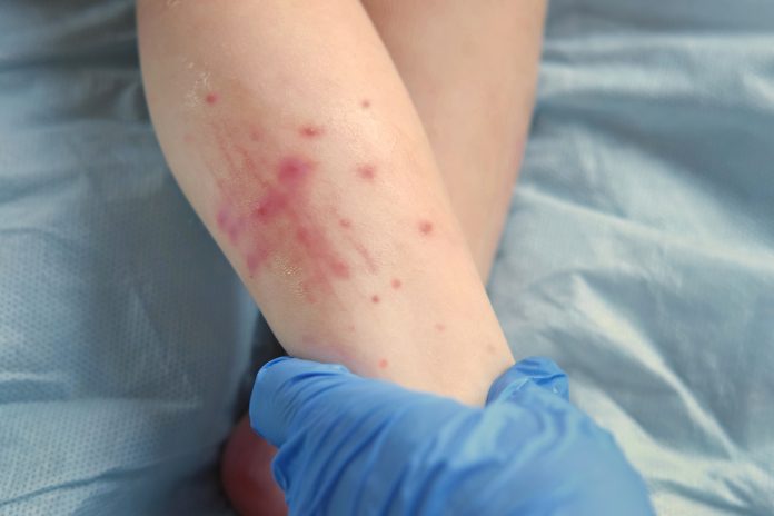 Why Measles Cases Are Rising Right Now