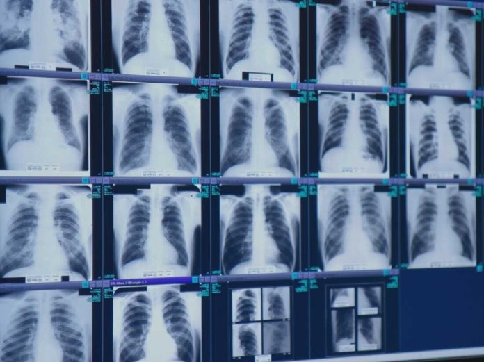 Finally, tough new safety rules are out to prevent severe black lung : Shots